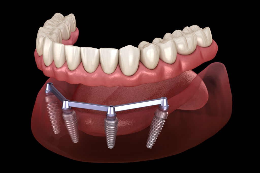 Benefits Of Dental Implants​