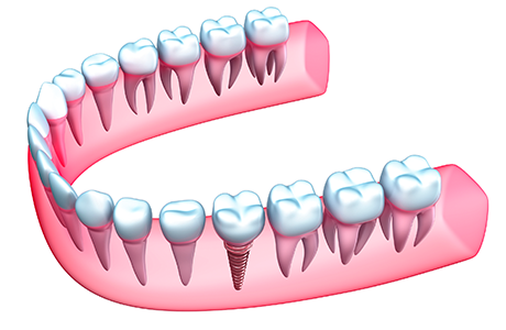 Long-Term Comfort And Success Of Dental Implants​